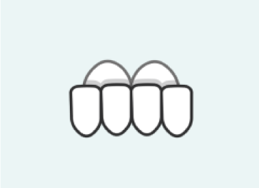 Overbite