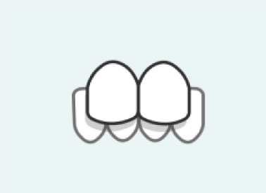 Underbite